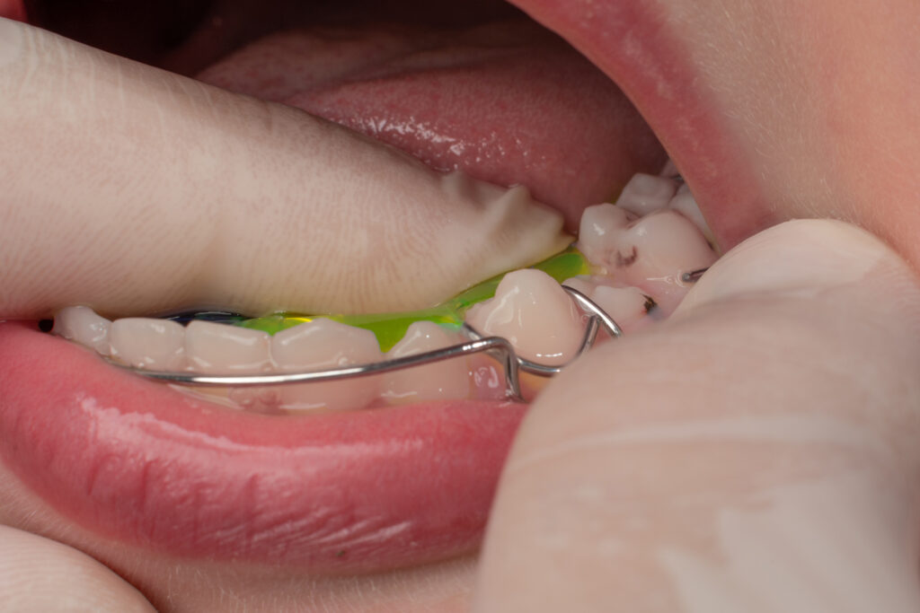Dental Implants Near Me Citra FL