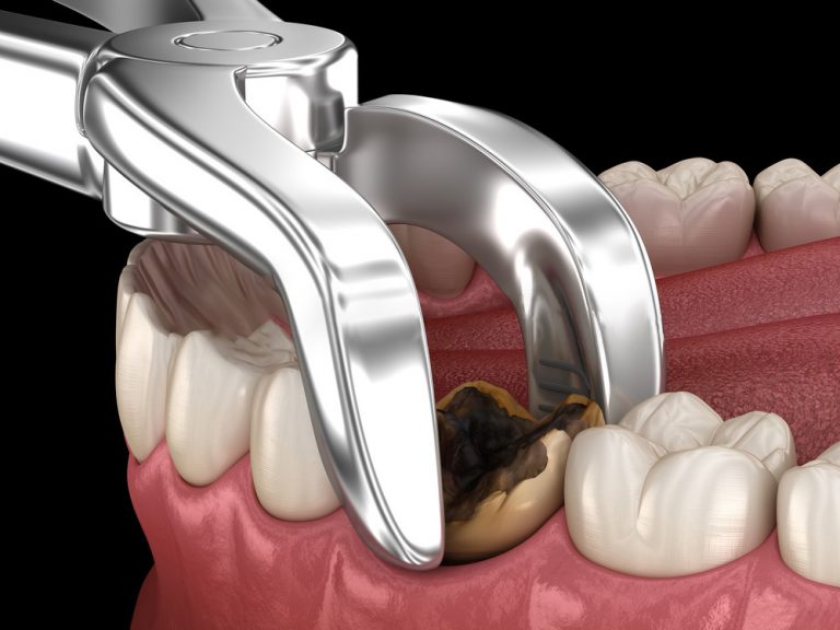 Clear Choice Dental Implant