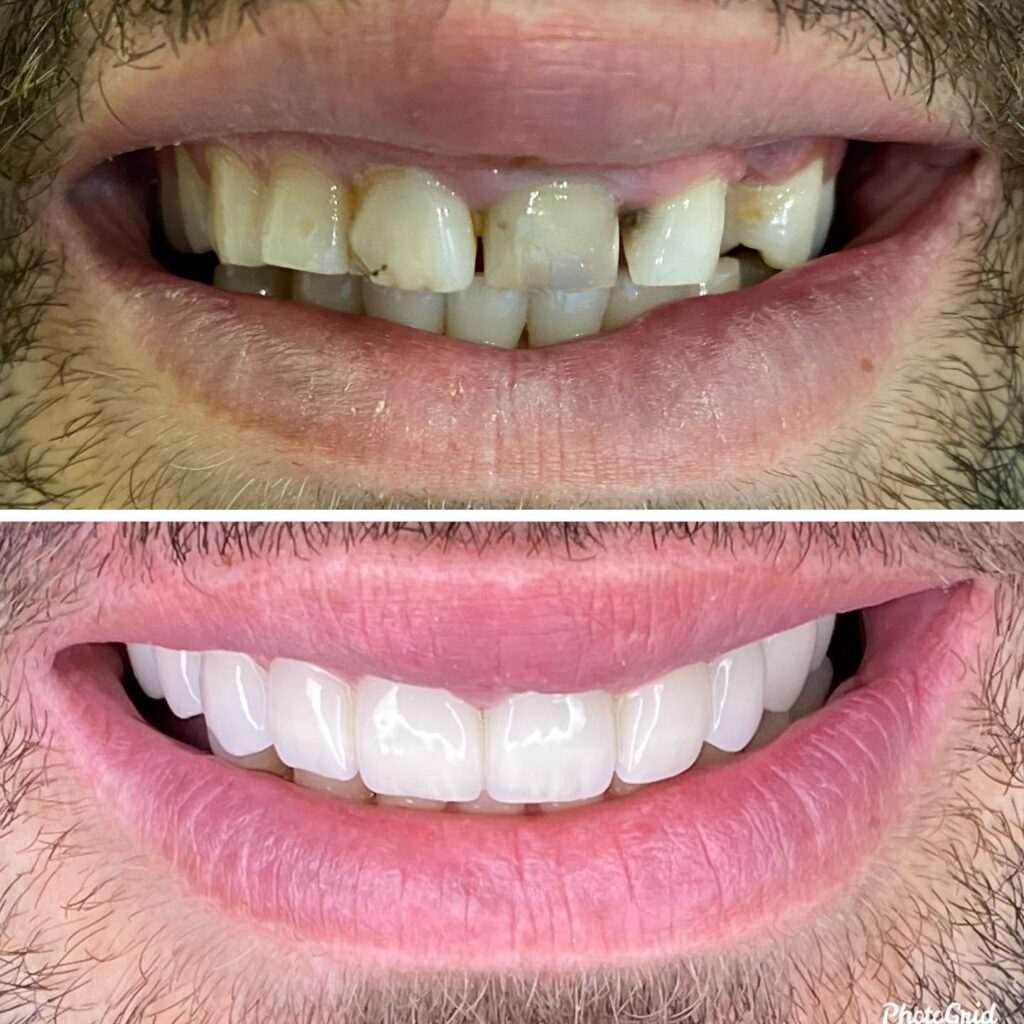 Dental Implant Before and After